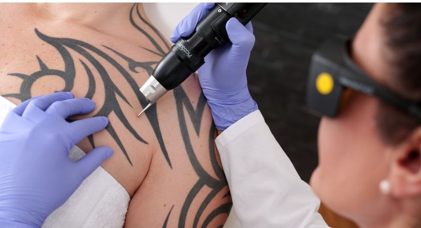 To musisz wiedzieć, zanim zdecydujesz się na usuwanie tatuażu. Doradzamy!
