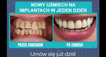 WeldOne Concept – pełny uśmiech w jeden dzień! - Precyzyjnie, bezpiecznie i bezboleśnie 